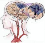 Ts Thiện Quang : Bệnh Tai Biến Mạch Máu Não - Bệnh Xuất Huyết Não