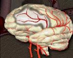 Tsthiệnquang : Tìm Hiểu Về Bệnh Tai Biến Mạch Máu Não