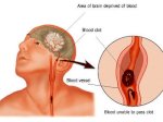 Bệnh Tai Biến Mạch Máu Não Và Thuốc Điều Trị