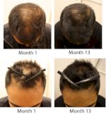 Thuốc Mọc Tóc Hair By Revitalash, Kích Thích Tóc Mọc Dài Nhanh Chóng, Dày Hơn