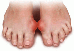 Bệnh Gout: Thuốc Chữa Bệnh Gút