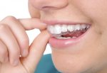 Giá Niềng Răng Sứ Và Những Ưu Điểm Của Niềng Răng