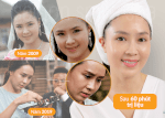 Saigon Smile Spa Giải Mã Nghi Án Nữ Diễn Viên Hồng Diễm Phẫu Thuật Căng Da