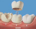 Giải Đáp Bọc Răng Sứ Có Cần Tẩy Tủy Không?