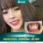 Trồng Răng Implant Bao Nhiêu Tiền Tại Hà Nội