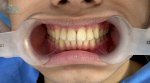 Nha Khoa Tẩy Trắng Răng Uy Tín, Chất Lượng Nhất Dr Smile