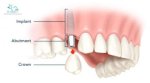 Trồng Răng Implant Của Đức Có Tốt Không?