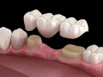 Top 5 Địa Chỉ Trồng Răng Implant Tại Đà Nẵng Chất Lượng