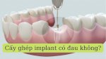 Top 5 Địa Chỉ Trồng Răng Implant Tại Tp. Vinh - Vatgia.com