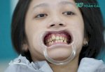 Các Loại Răng Cần Niềng Và Thời Điểm Vàng Niềng Răng