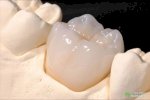 Top 11 Địa Chỉ Trồng Răng Implant Nha Trang Chất Lượng Nhất