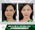 Cấy Chỉ Pdo Là Gì? Hiệu Quả Có Tốt Không?