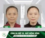 Máy Làm Căng Da Mặt Có Tốt Không?