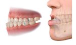 Phẫu Thuật Chữa Tụt Lợi Chân Răng: Quy Trình Và Chi Phí
