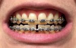 Các Dấu Hiệu Bình Thường Và Bất Thường Sau Khi Lấy Tủy Răng