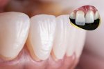 Chăm Sóc Răng Sứ Veneer Đúng Cách: Bảo Đảm Sức Khỏe Răng Miệng Và Độ Bền