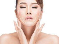 Căng Da Mặt Bằng Chỉ Collagen Giá Ra Sao