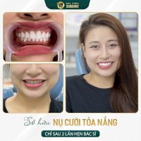 Răng Sứ Alumina Giá Bao Nhiêu? Khám Phá Ngay!