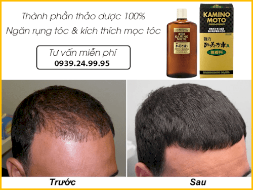 Thuốc trị hói đầu Kaminomoto Higher Strength